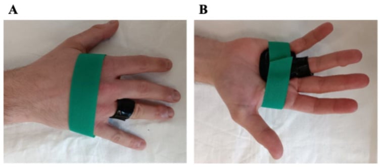 MCP-blocking splint for trigger finger seen from the dorsum and the palm