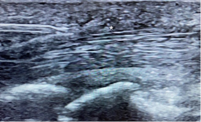 Long-axis ultrasound with the release needle running parallel to the tendon fibres