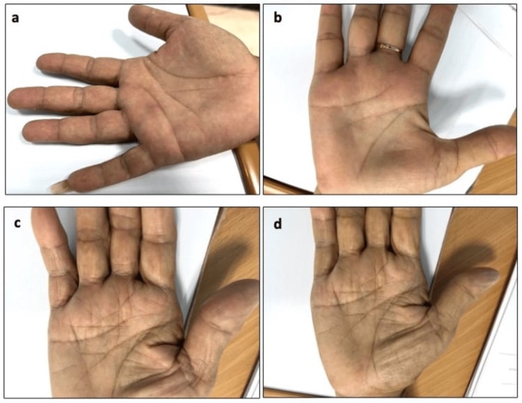Four palmar views of hands after percutaneous and open trigger release