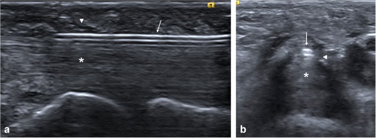 Long- and short-axis ultrasound with the needle superficial to the flexor tendons during A1 fenestration