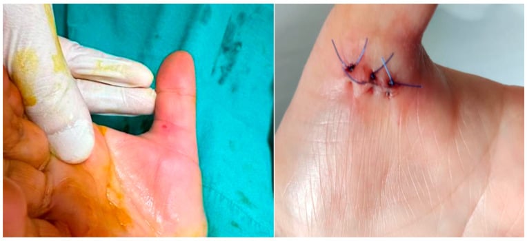 Wounds after ultrasound-guided and open A1 pulley release