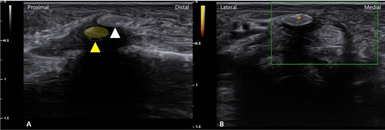 Long-axis and transverse power Doppler ultrasound of calcification at the A1 pulley