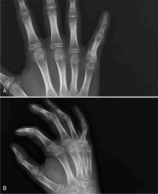 Hand radiographs of a paediatric flexor-tendon entrapment mimicking trigger finger