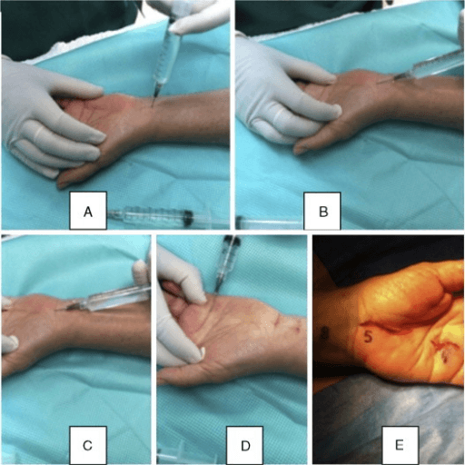 Local anaesthetic infiltration for awake hand surgery