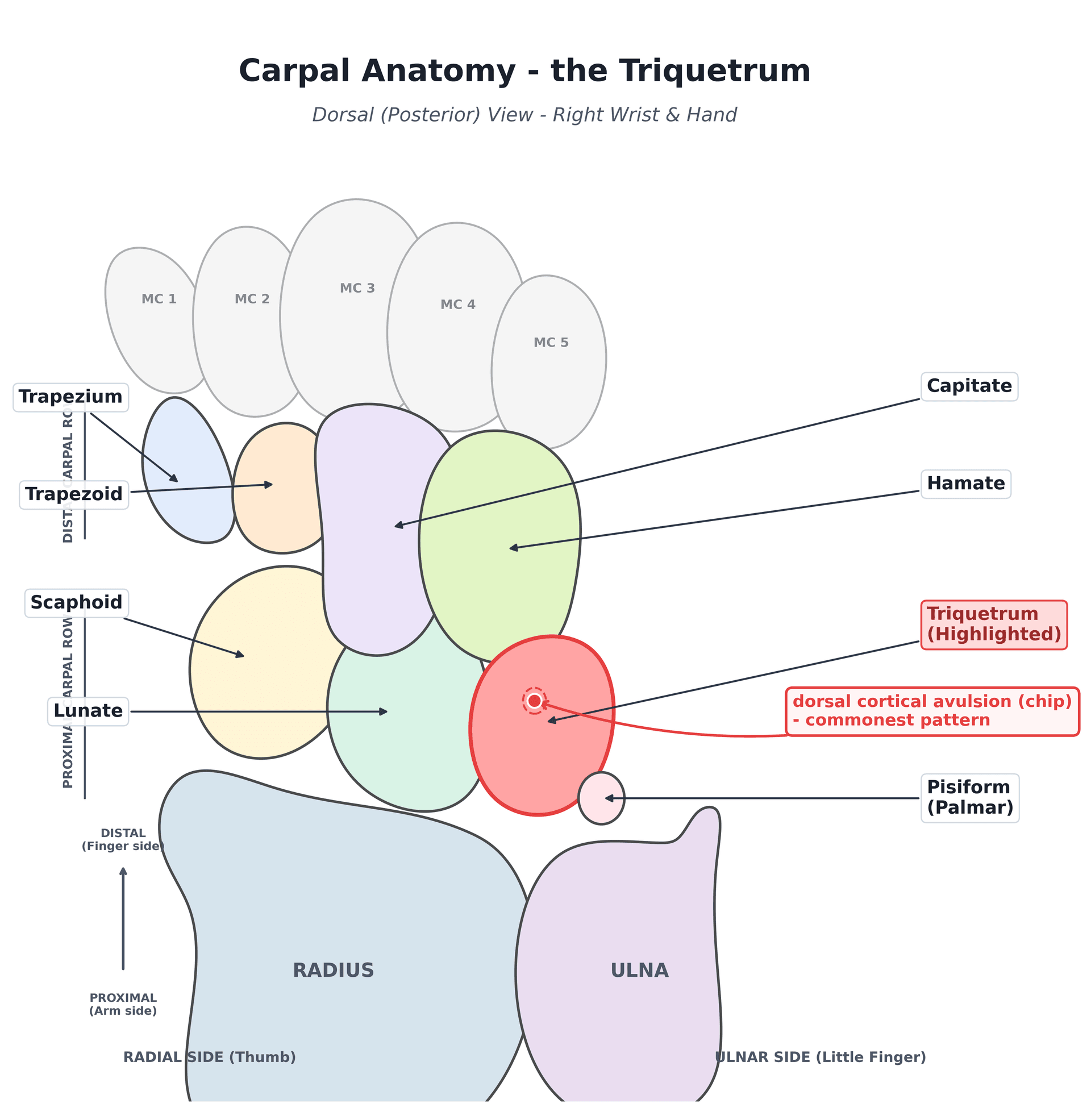 Dorsal anatomy diagram of the carpus highlighting the triquetrum and the dorsal cortical avulsion site