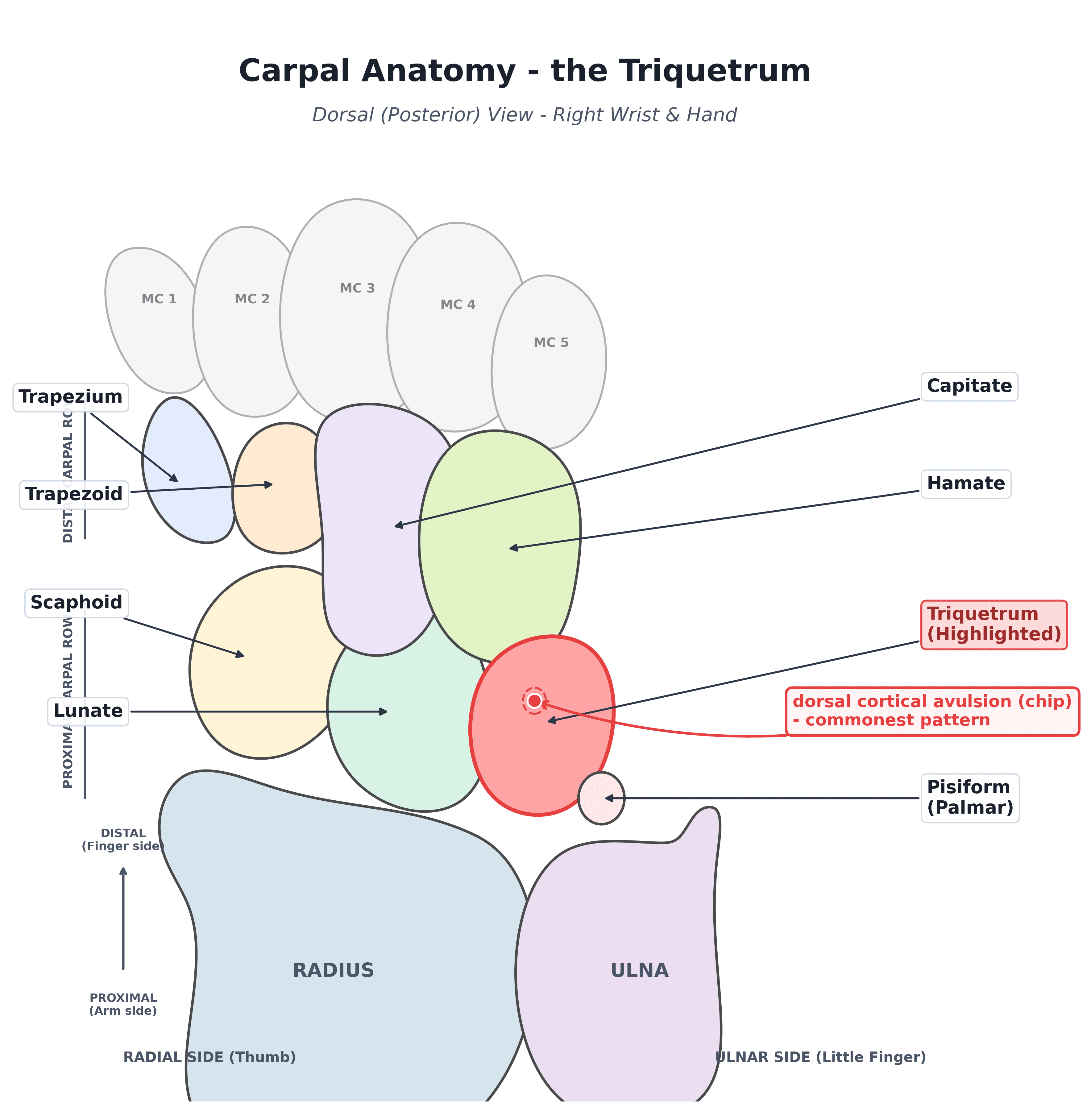 Dorsal anatomy diagram of the carpus highlighting the triquetrum and the dorsal cortical avulsion site