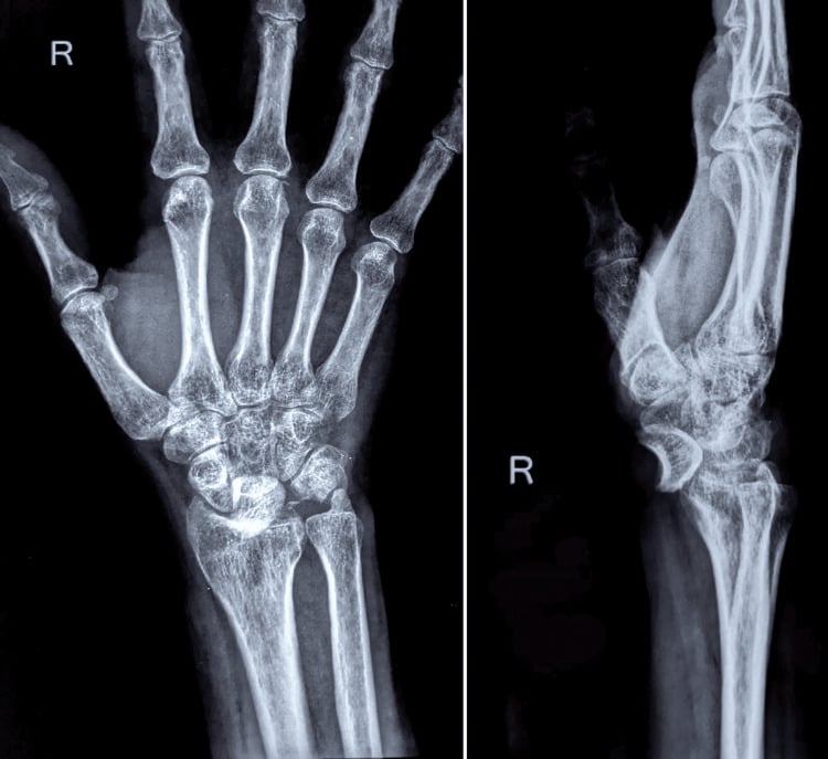 PA and lateral wrist radiographs showing volar lunate dislocation with an associated triquetral avulsion fracture