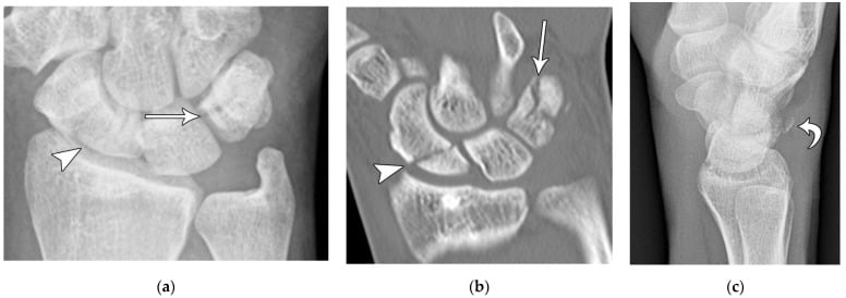 PA radiograph and coronal CT of a triquetral body fracture with a separate lateral radiograph showing a dorsal cortical avulsion
