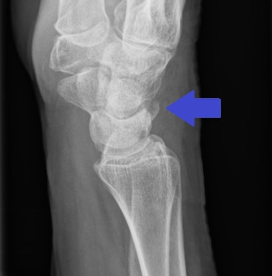 Lateral wrist radiograph showing a dorsal triquetral avulsion fracture marked by an arrow.