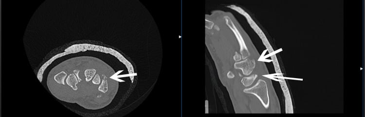 Axial and sagittal CT images showing dorsal fractures of the triquetrum and hamate