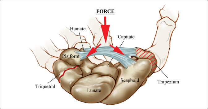 Carpal diagram showing force transmitted through the transverse carpal ligament ring toward the hamate and triquetrum
