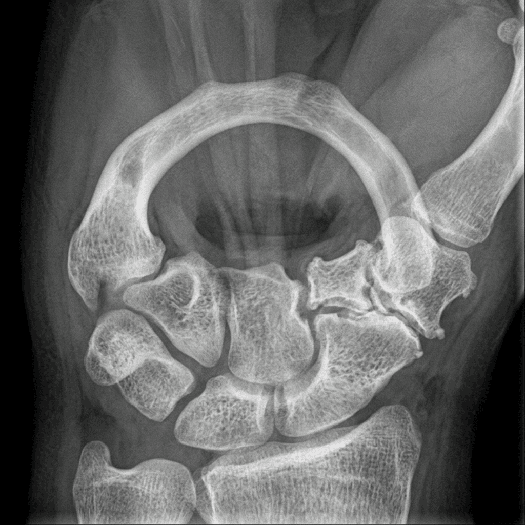 Carpal tunnel (skyline) view radiograph showing the tunnel-shaped ring of carpal bones profiling the scaphotrapeziotrapezoid region.