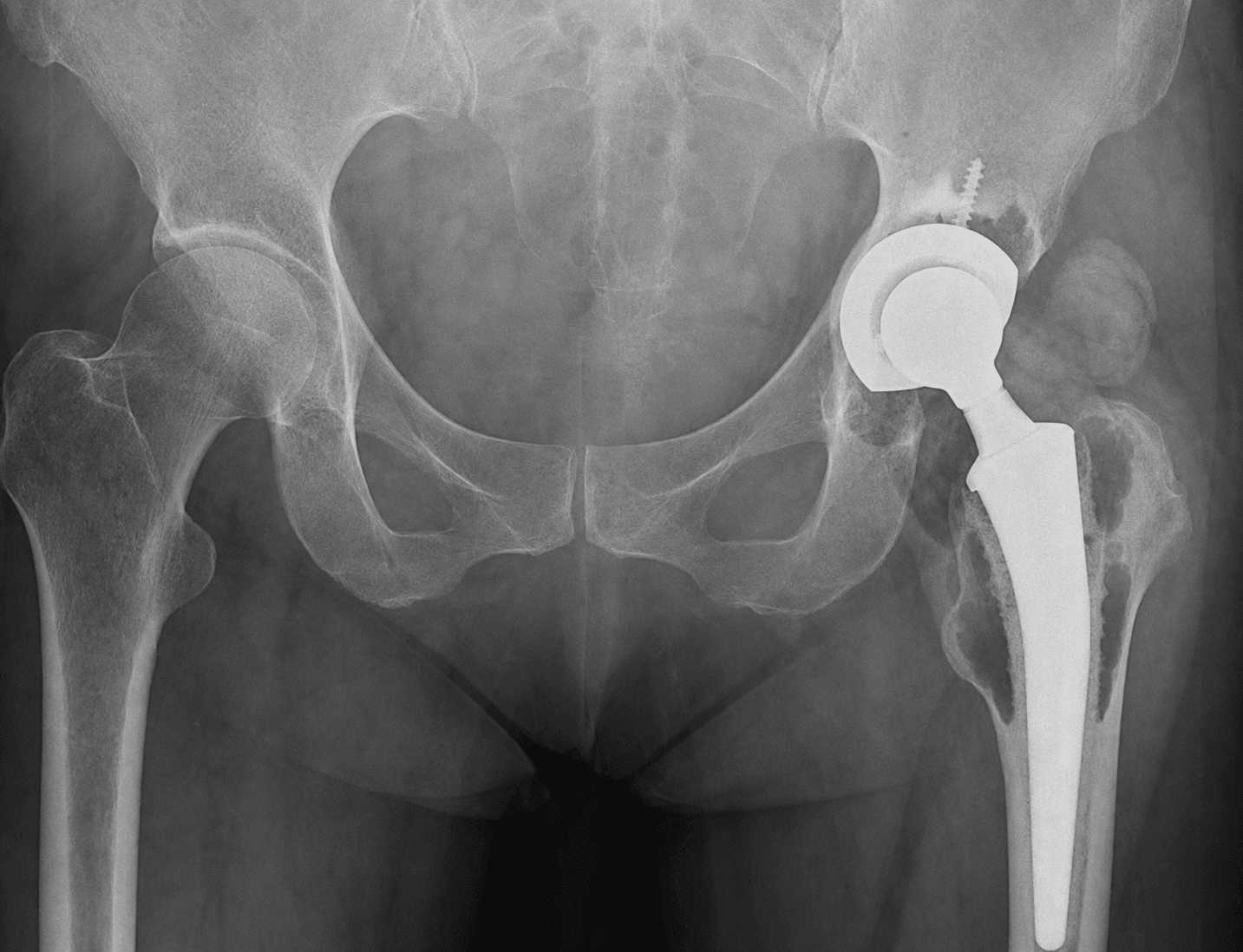AP pelvic radiograph showing a total hip replacement, used to assess the components in suspected trunnionosis.
