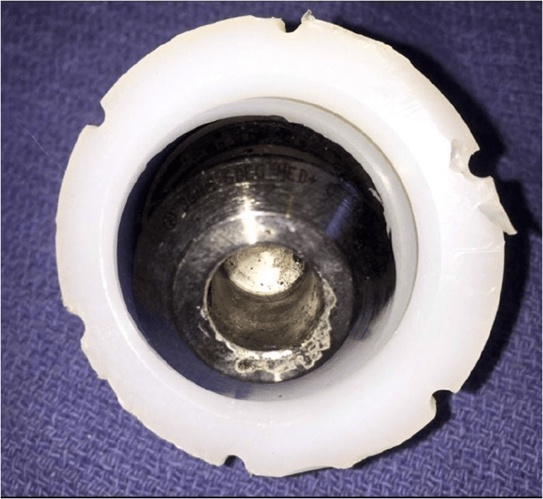 Cobalt-chromium femoral head from a metal-on-polyethylene THA, seated in its liner and viewed into a darkened taper bore