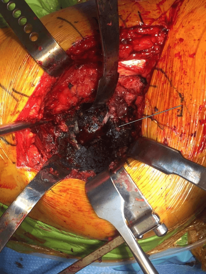 Intra-operative view of black-stained periprosthetic tissue at revision for trunnion failure