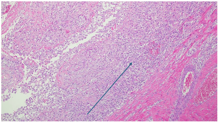 Histology showing histiocyte-rich chronic inflammation around arthroplasty debris