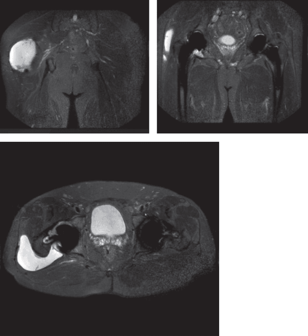 MRI showing a large posterior periprosthetic fluid collection around the right hip