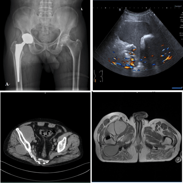 Pelvic radiograph, ultrasound, axial CT and axial MRI of an inflammatory pseudotumour around a right THA