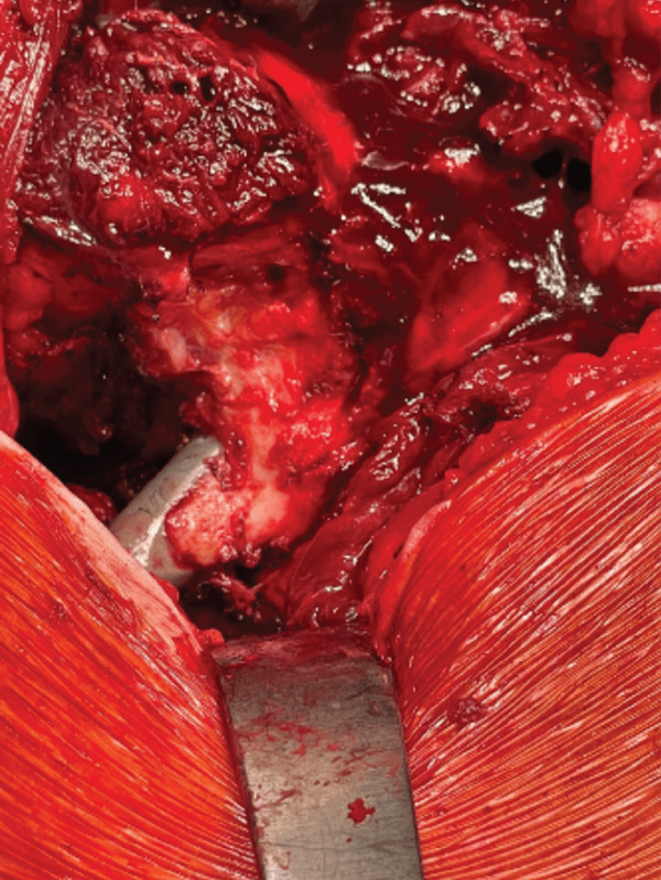 Operative exposure of the proximal femur and a metal component within extensive dark devitalised-appearing tissue
