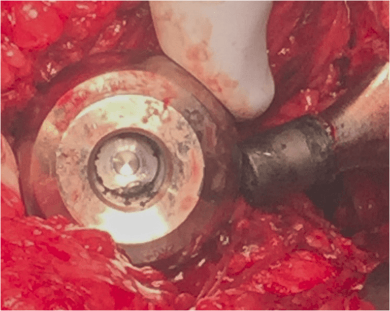 Intra-operative view of a disengaged femoral head bore with dark deposits and a blackened trunnion