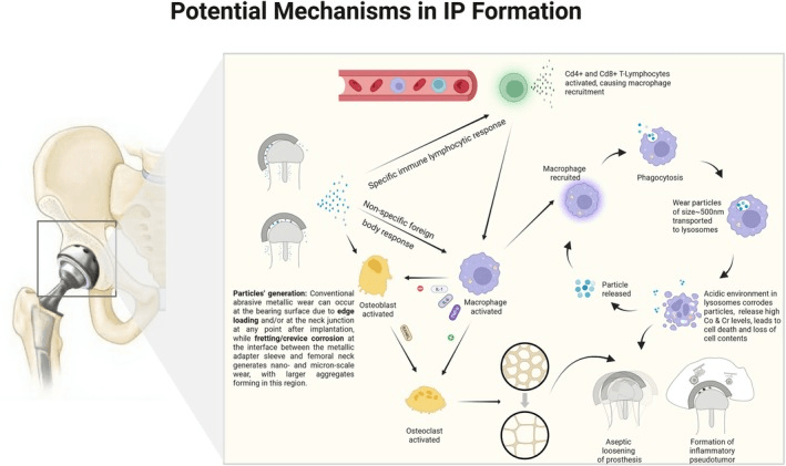 Diagram of potential mechanisms of inflammatory pseudotumour formation from bearing and neck-junction particles
