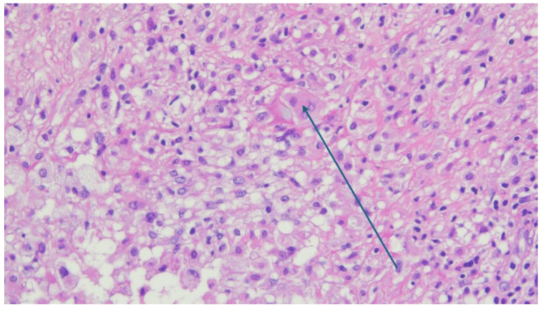Higher-power histology of foamy histiocytes and a multinucleated giant cell around exogenous arthroplasty material