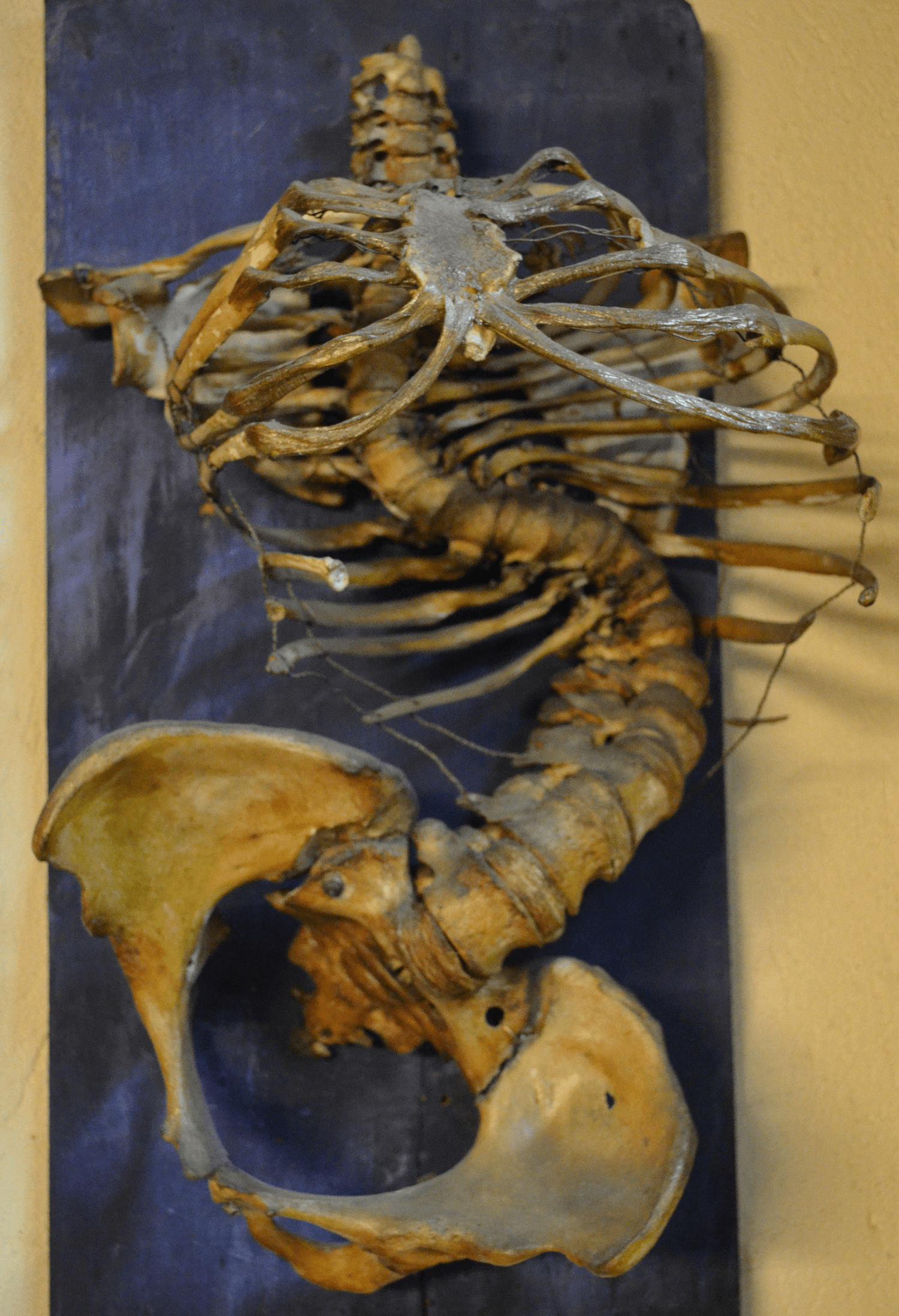 Skeletal specimen showing the sharp angular kyphosis (gibbus) of the thoracolumbar spine in Pott's disease.