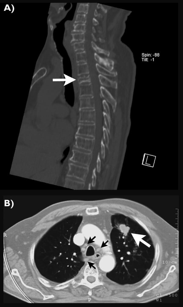 Sagittal CT of T3 lytic collapse with adjacent endplate destruction, plus chest CT of the left-upper-lobe nodule
