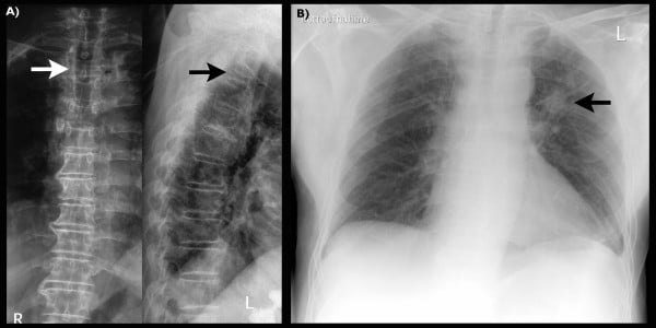 AP and lateral thoracic spine radiographs showing T3 collapse, and a chest radiograph with a left-upper-zone pulmonary nodule