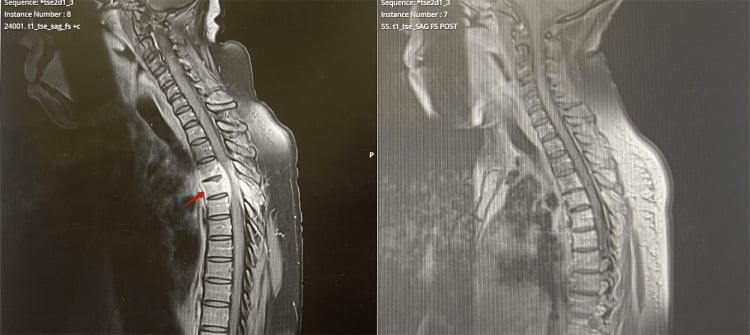 Sagittal MRI before and two months after antitubercular therapy showing reduced paravertebral enhancement and improved cord decompression