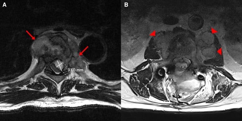Axial T2 MRI at T6 showing a thoracic epidural collection and bilateral paravertebral abscesses, with a second axial at L2