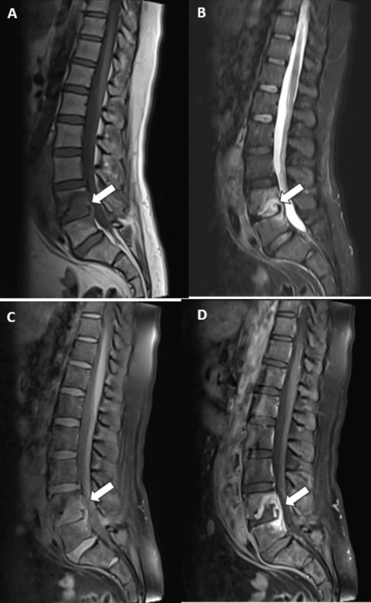 Sagittal T1, STIR and pre- and post-contrast T1 MRI of L4 tuberculous spondylitis with a relatively preserved L4/5 disc