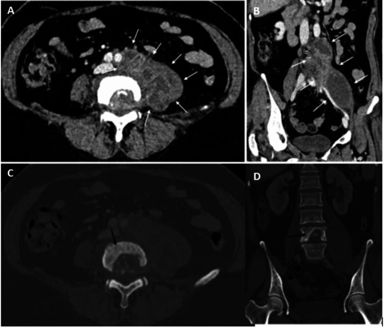 Axial and coronal portal-venous CT of a large left psoas abscess with lytic destruction of L4