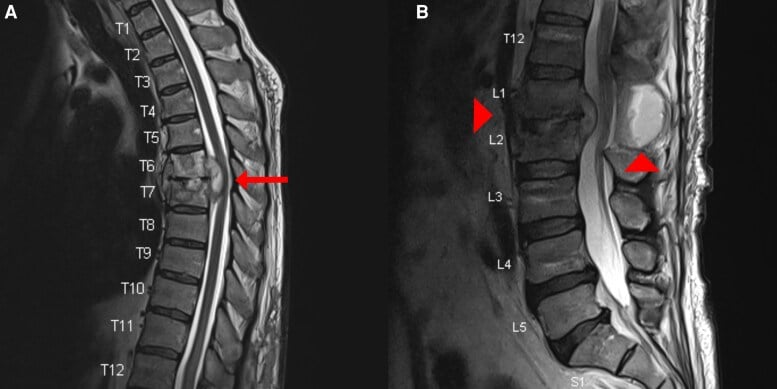 Sagittal T2 MRI of thoracic and lumbar spine showing T6-T7 spondylodiscitis with epidural abscess and a separate lumbar focus