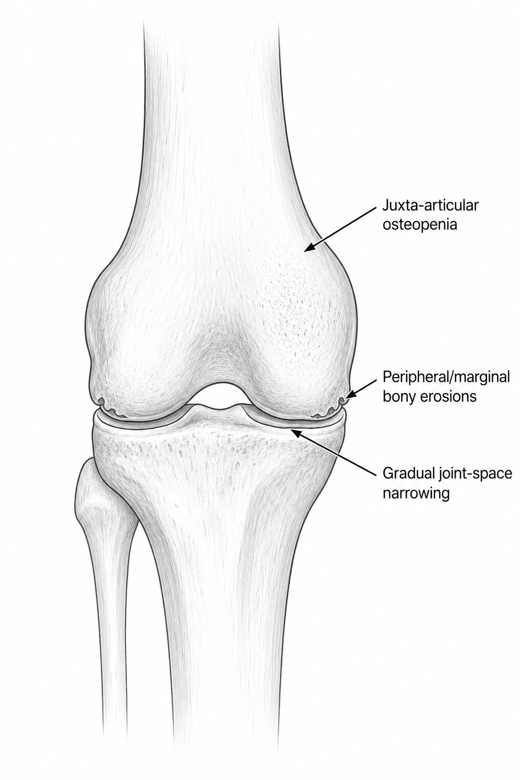 Diagram of a knee showing the Phemister triad: juxta-articular osteopenia, peripheral marginal bony erosions and gradual joint-space narrowing