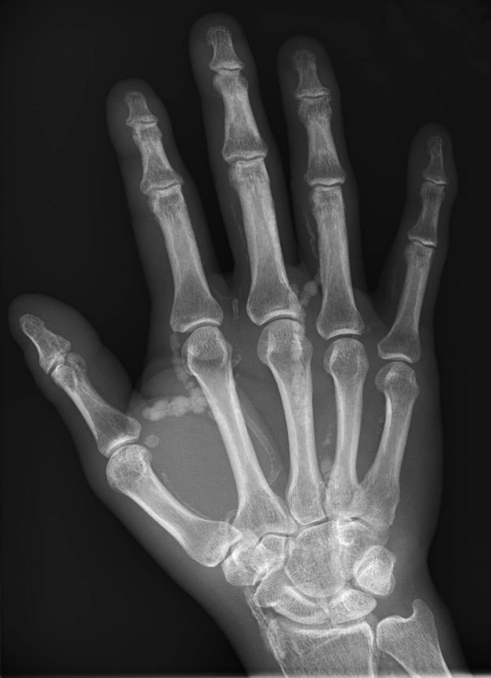 PA hand radiograph showing lobulated globular soft-tissue calcific deposits clustered around the joints, consistent with tumoral calcinosis.
