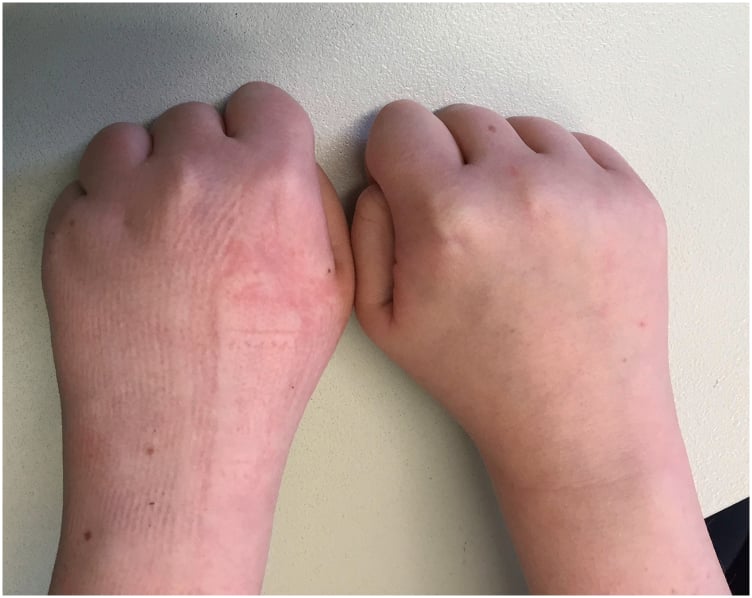 Clenched-fist views showing loss of the fourth knuckle prominence in Turner syndrome