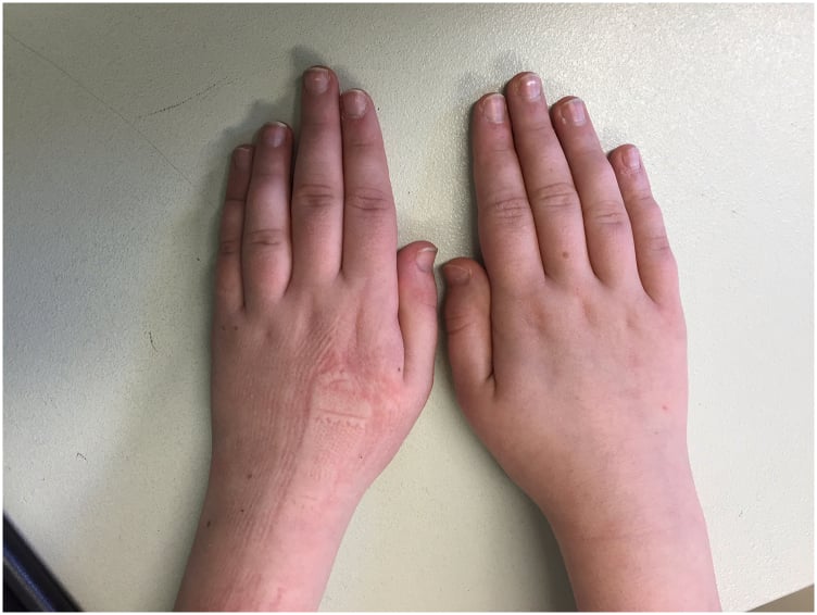 Clinical photograph of both hands showing a shortened ring finger