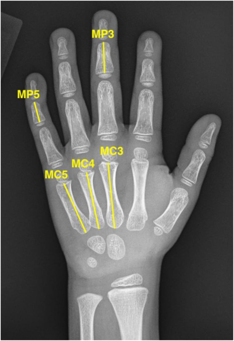 Hand radiograph labelled with metacarpal and middle phalanx measurement landmarks