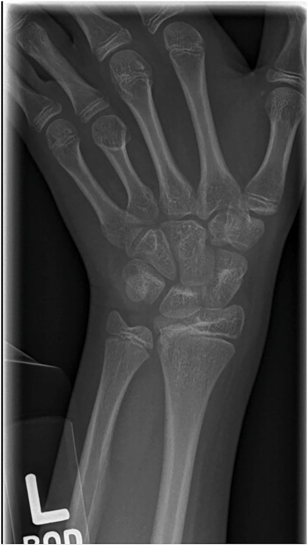 PA left hand radiograph showing a short fourth metacarpal, the positive metacarpal sign