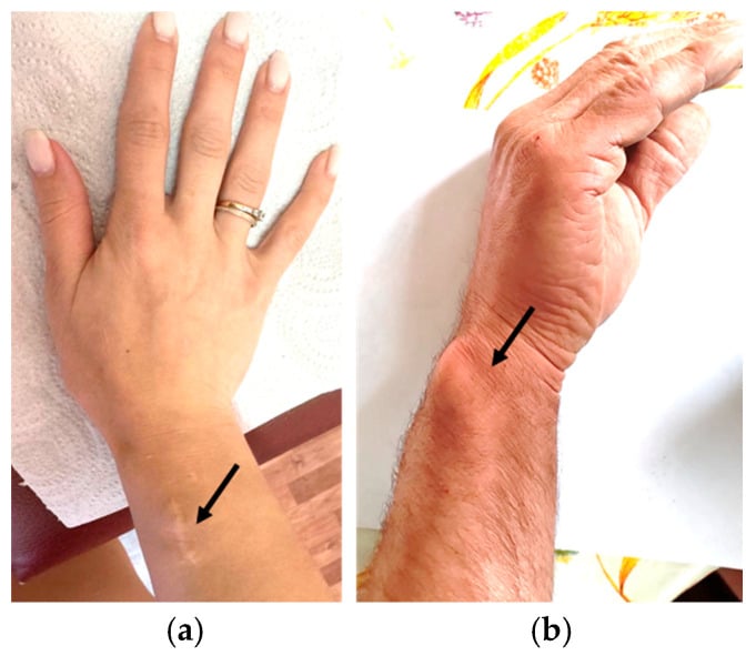 Clinical wrist views showing SHOX-associated Madelung deformity and a corrected wrist