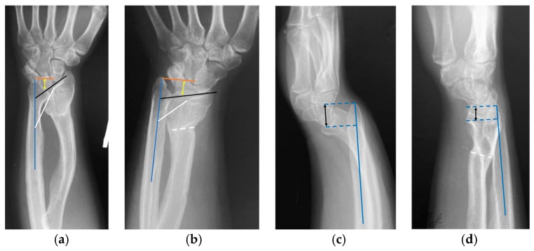 Wrist radiographs before and after correction of SHOX-associated Madelung deformity