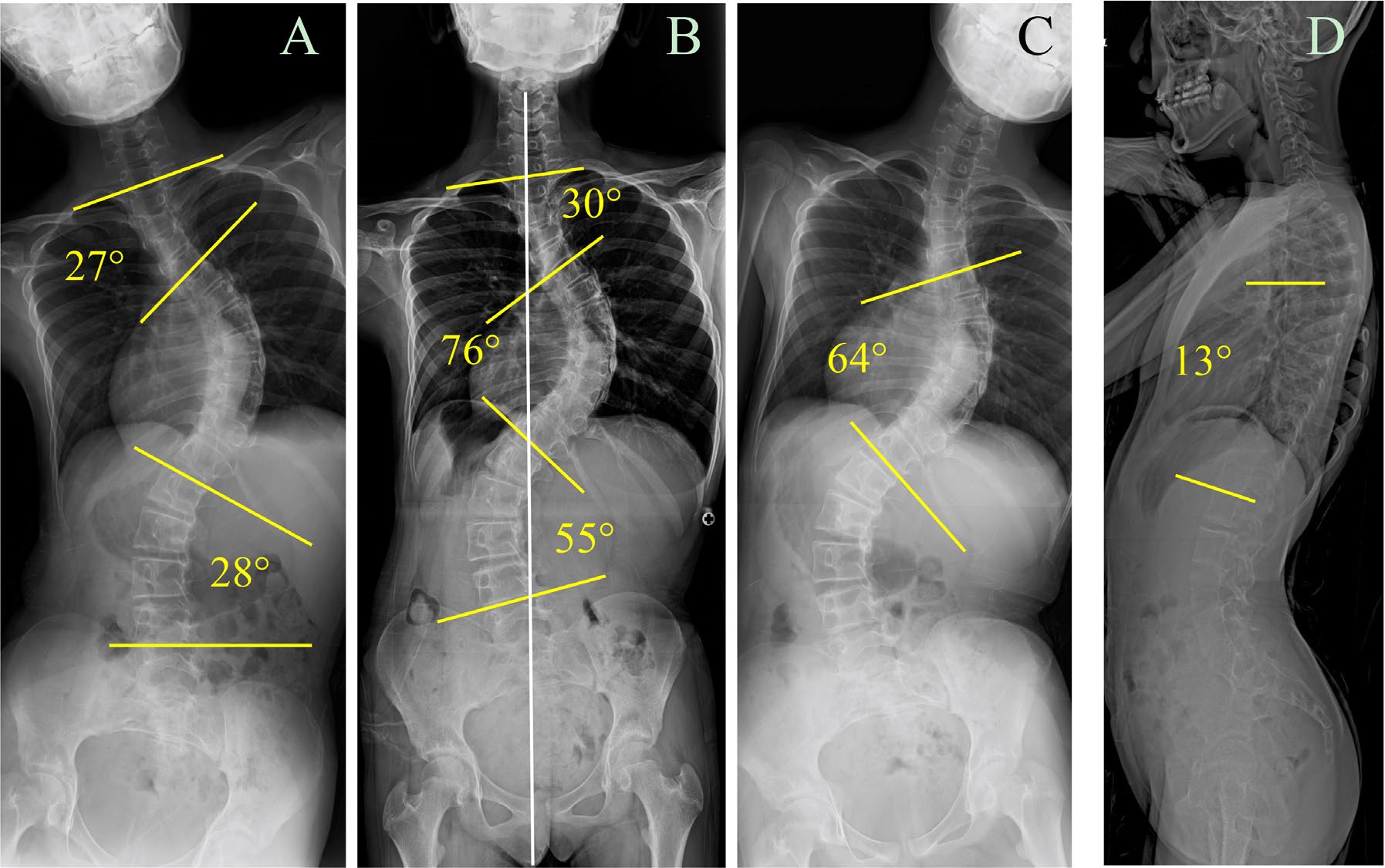 Standing and side-bending radiographs used to assess scoliosis flexibility in Turner syndrome