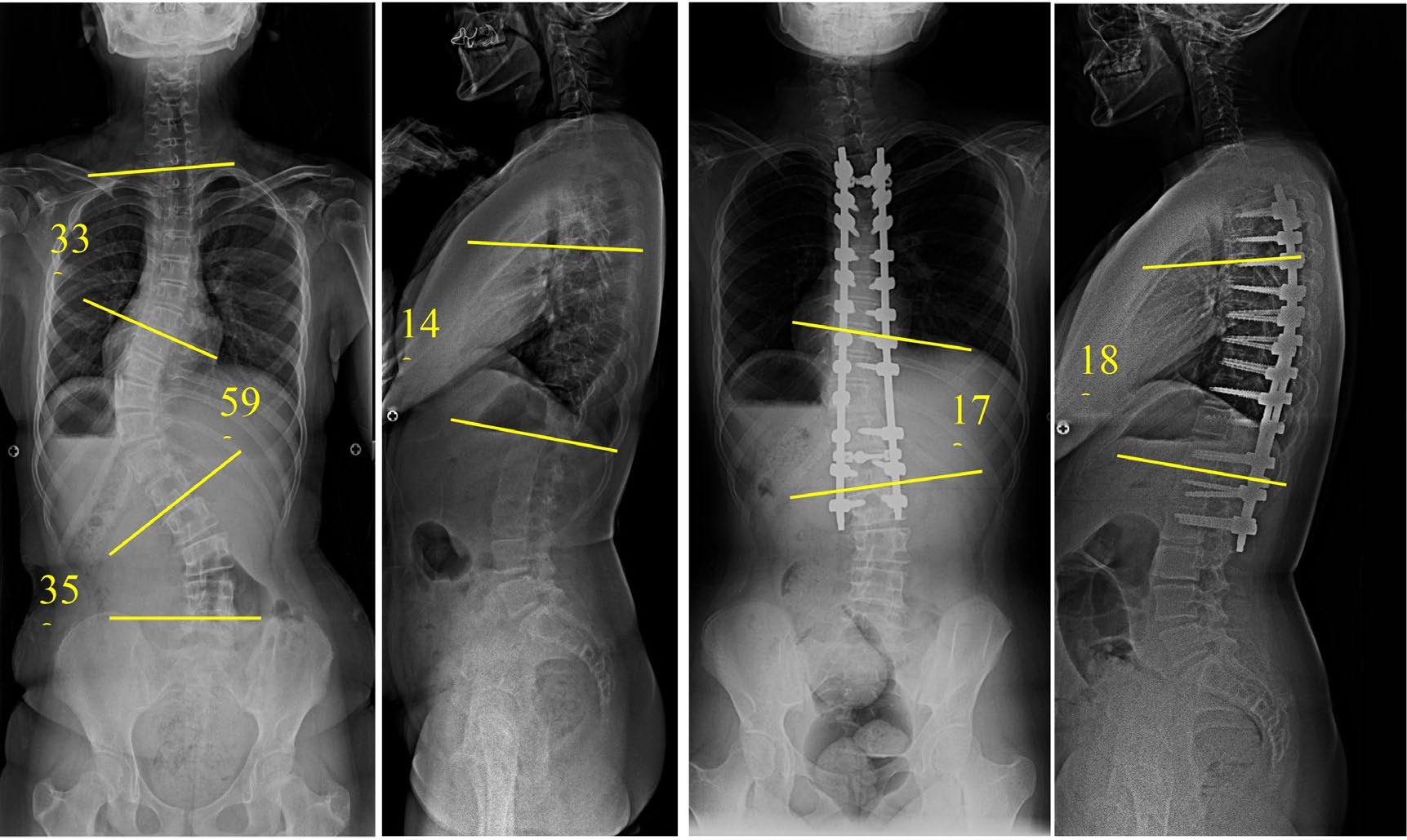 Preoperative and postoperative scoliosis radiographs from a second Turner syndrome case
