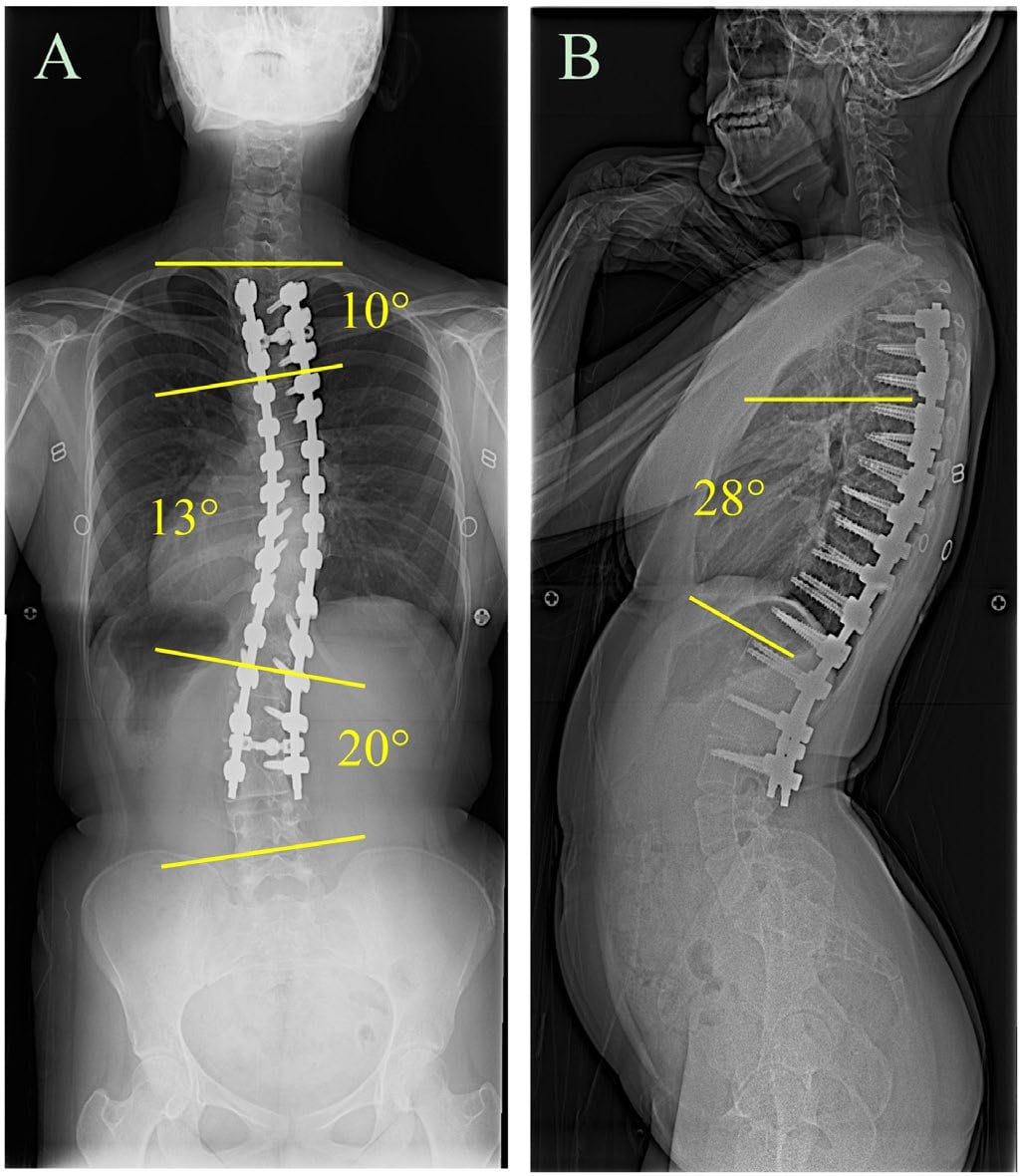 Long-term postoperative spine radiographs after scoliosis correction in Turner syndrome