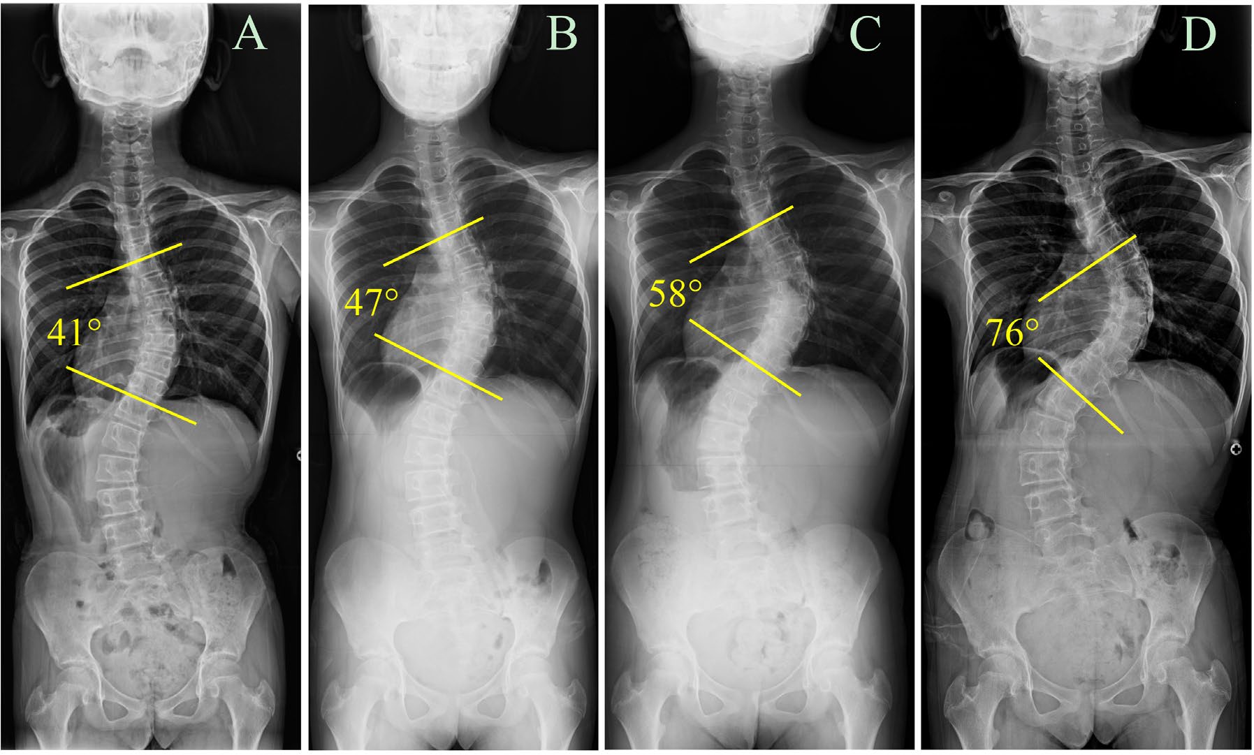 Serial standing spine radiographs showing rapid scoliosis progression in Turner syndrome