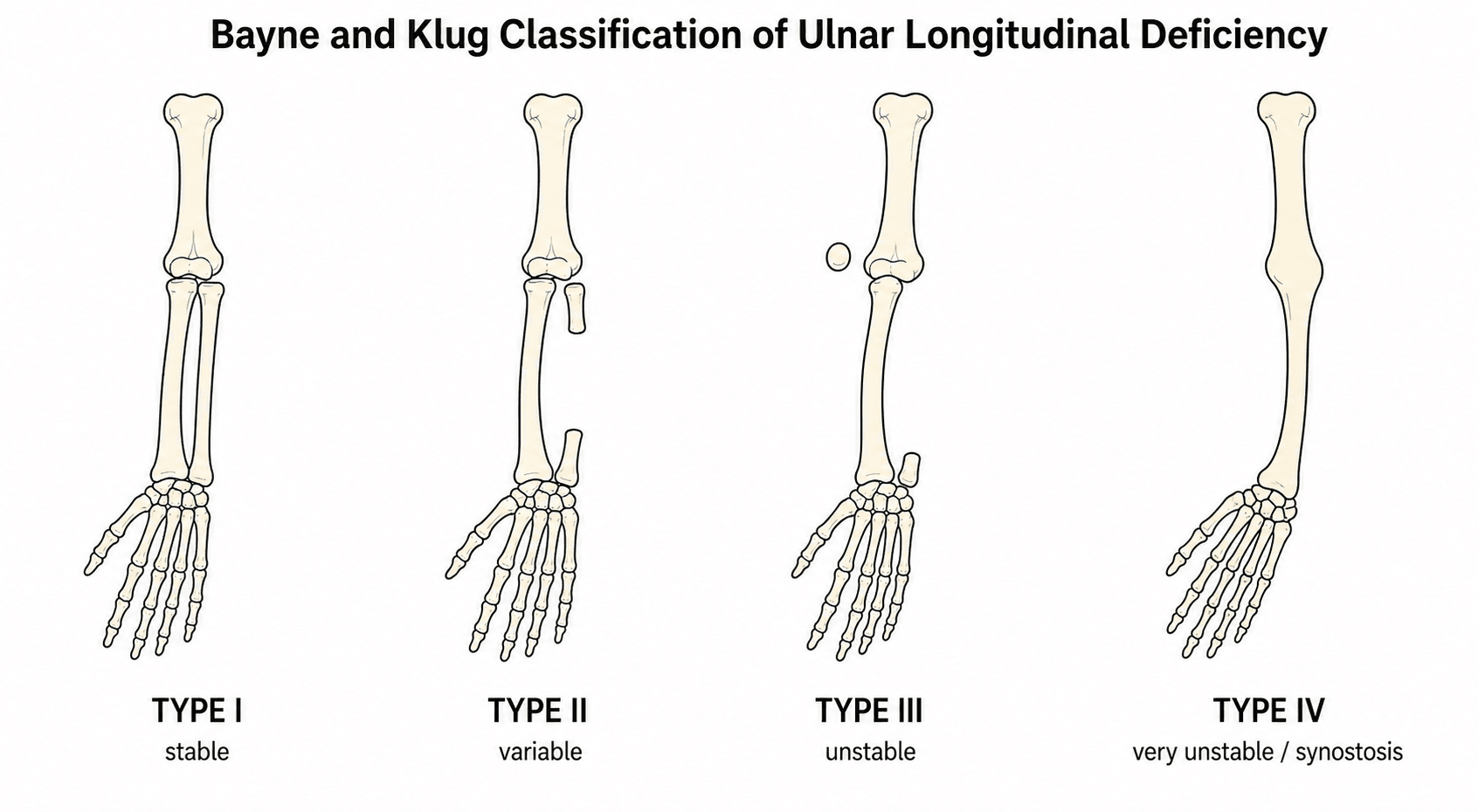 Schematic diagram of the four Bayne types of ulnar longitudinal deficiency, showing the forearm bones and elbow stability for each type.