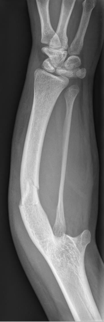AP radiograph of a short, bowed forearm with the carpus and metacarpals at the wrist, consistent with a longitudinal forearm deficiency.