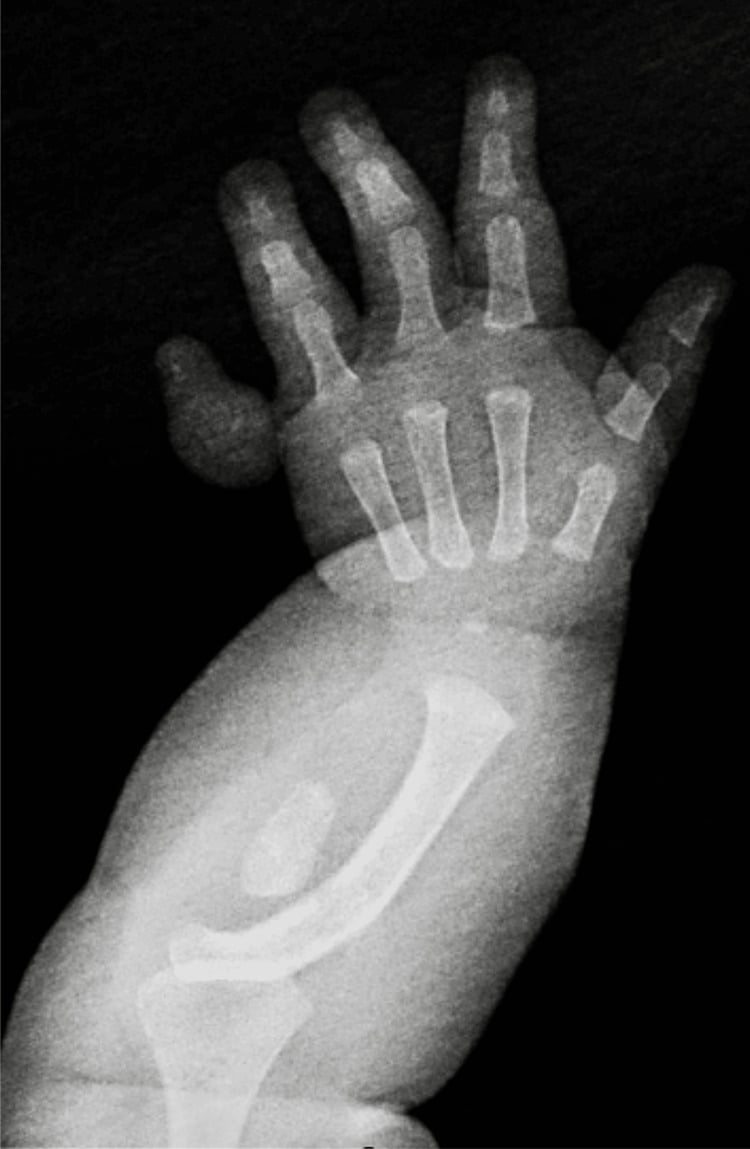 Clinical photographs of ulnar longitudinal deficiency showing forearm shortening and ulnar deviation