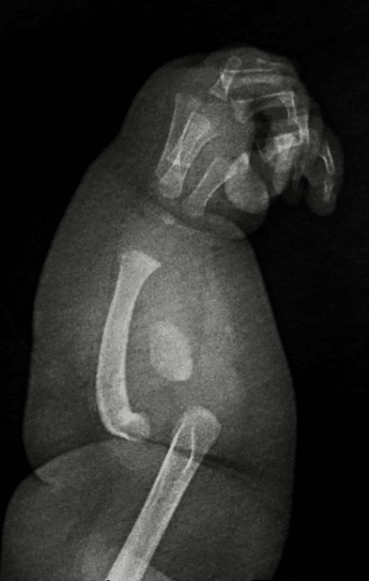 Forearm radiographs demonstrating complete absence of ulna and radial bowing in ulnar deficiency